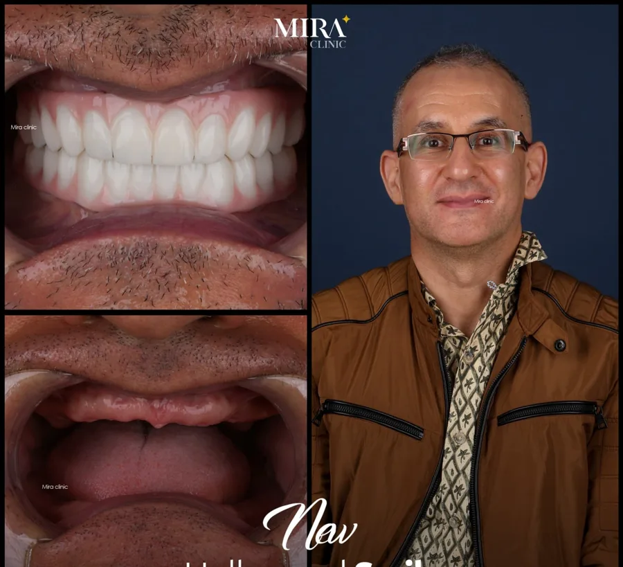 Illustrative hollywood smile result sample