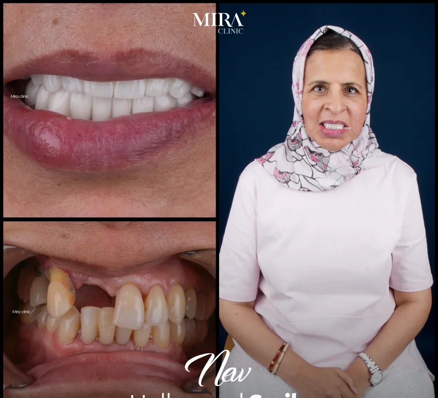 Illustrative hollywood smile result sample