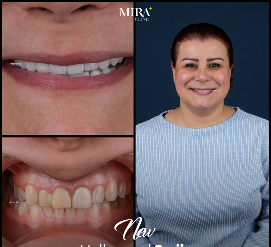 محاكاة توضيحية قبل تجميل الأسنان