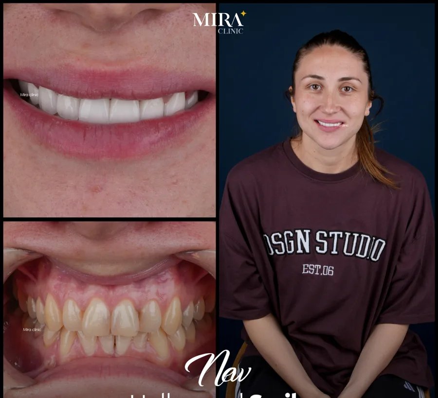 Illustrative hollywood smile result sample