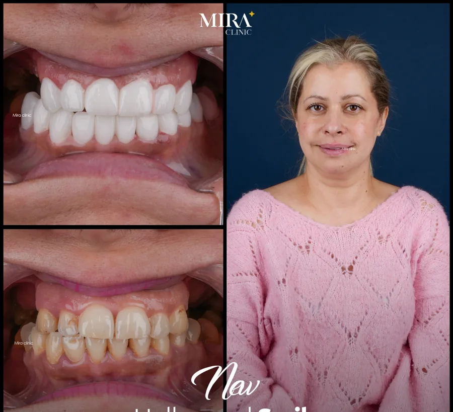 Illustrative hollywood smile result sample