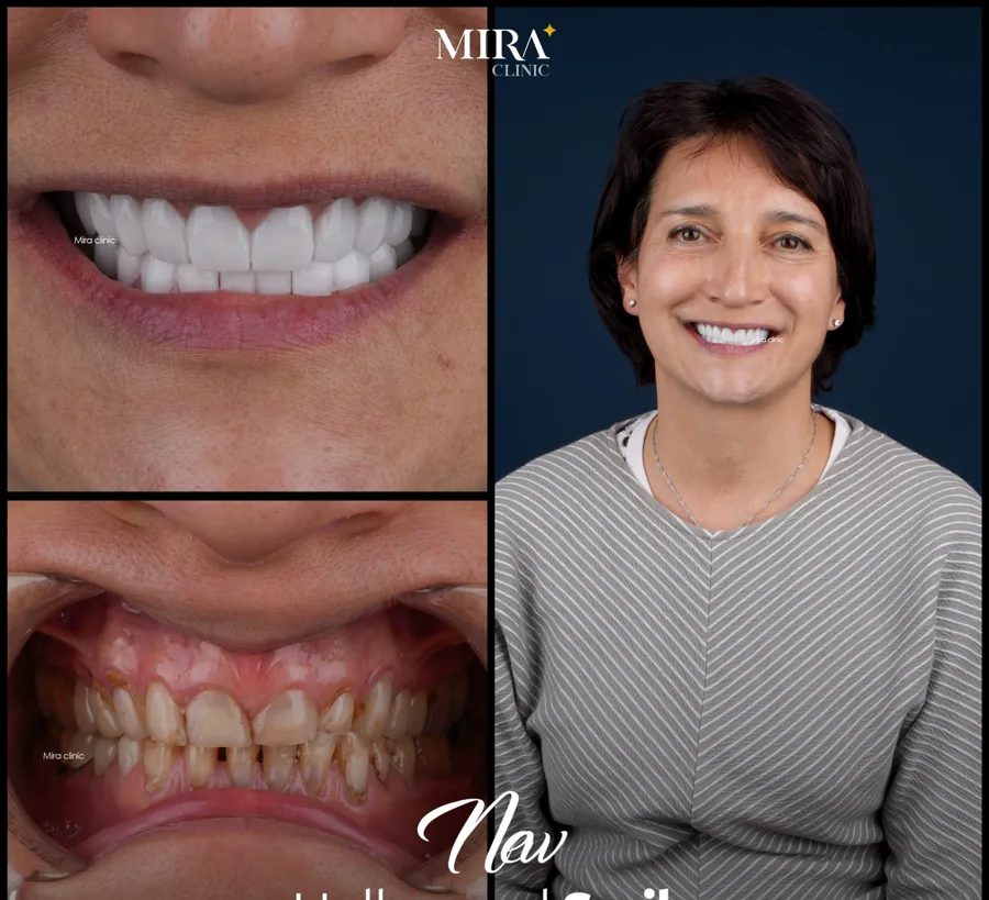Illustrative hollywood smile result sample